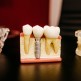 Czy implanty zębowe trzeba wymieniać?