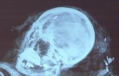 Zdjęcie czaszki gen. Władysława Sikorskiego.